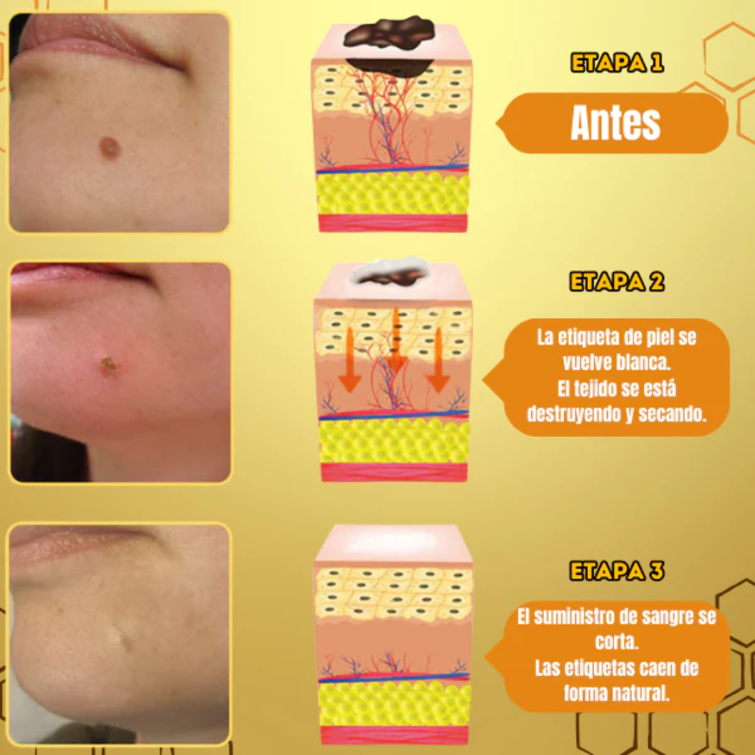 TAG RECEDE VENENO DE ABEJA — Elimina verrugas y etiquetas de piel con veneno de abeja en casa, sin dolor y sin cirugía